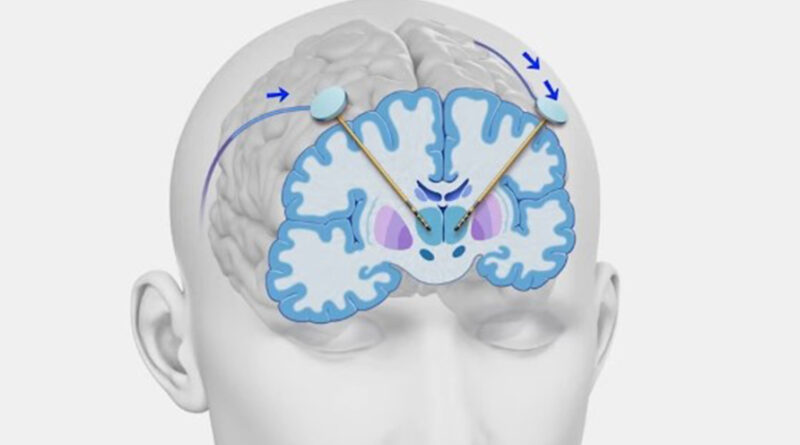 Deep Brain Stimulation Surgery