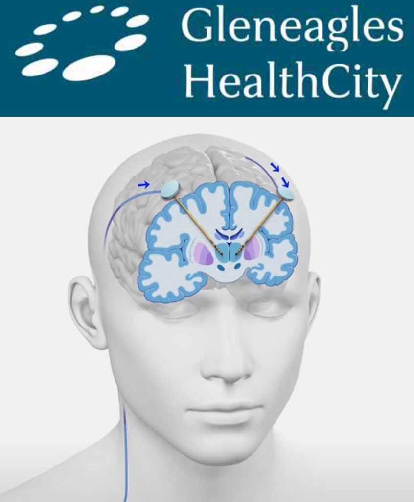 Deep Brain Stimulation Surgery